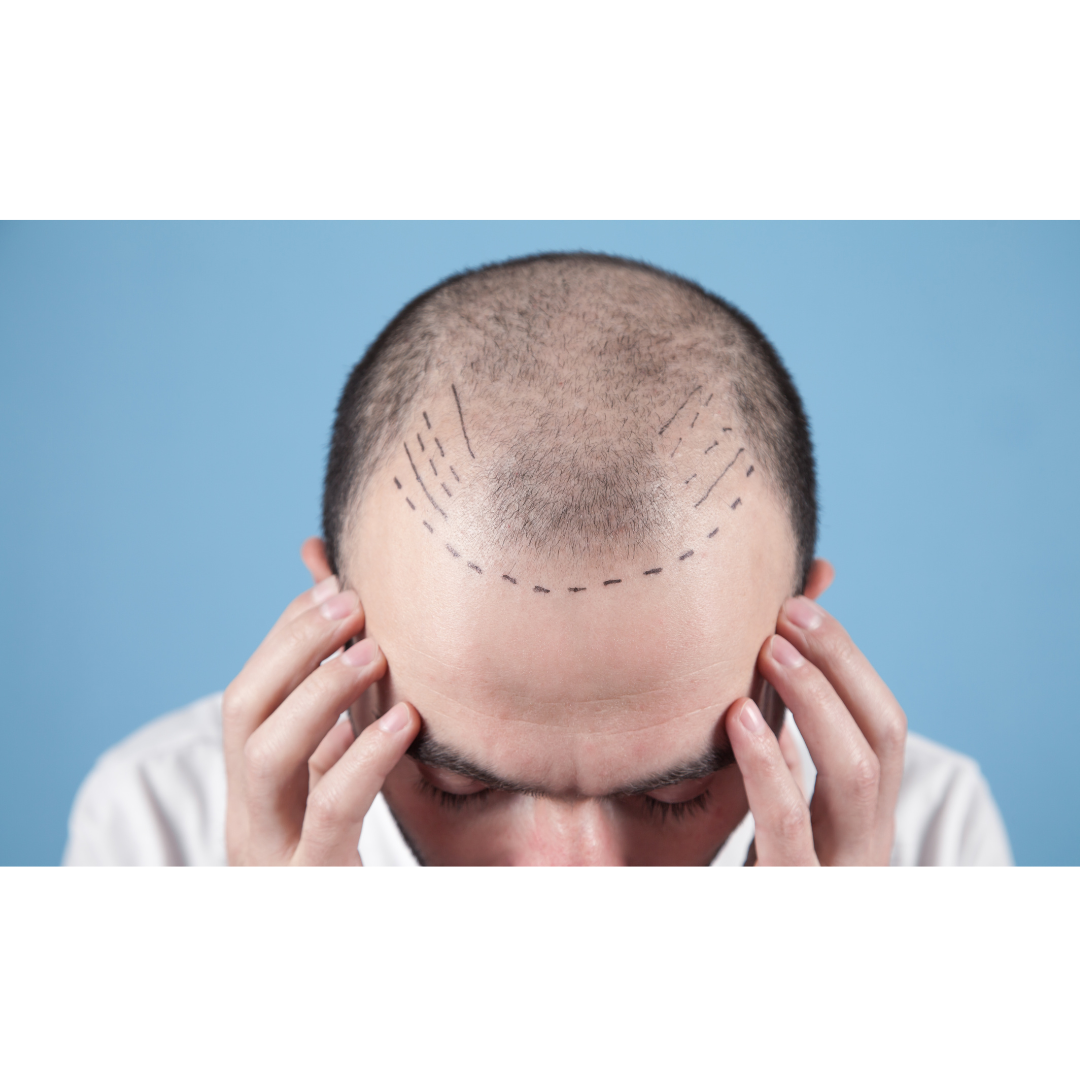Hair Transplant Preparation