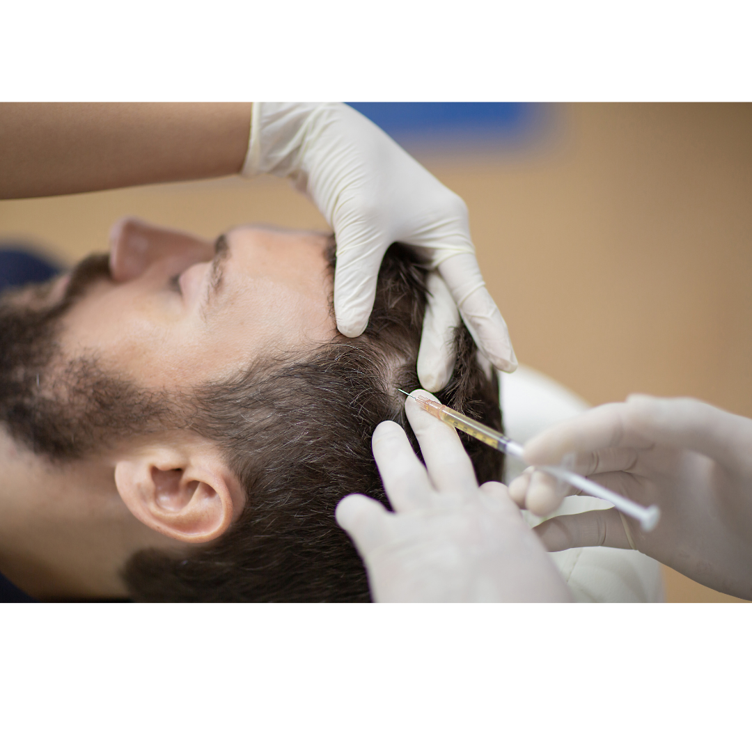 Anti Hair Loss Mesotherapy