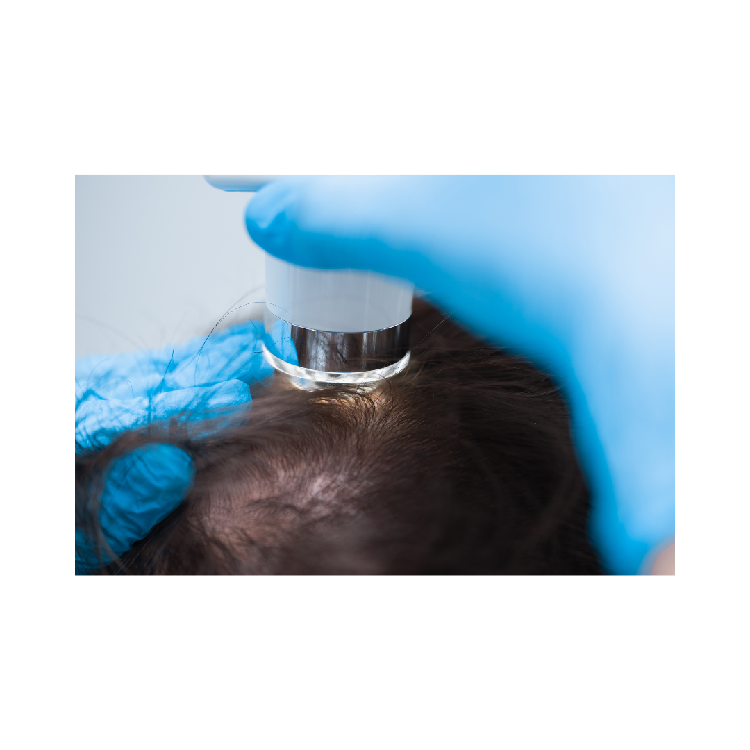 Scalp Carboxytherapy