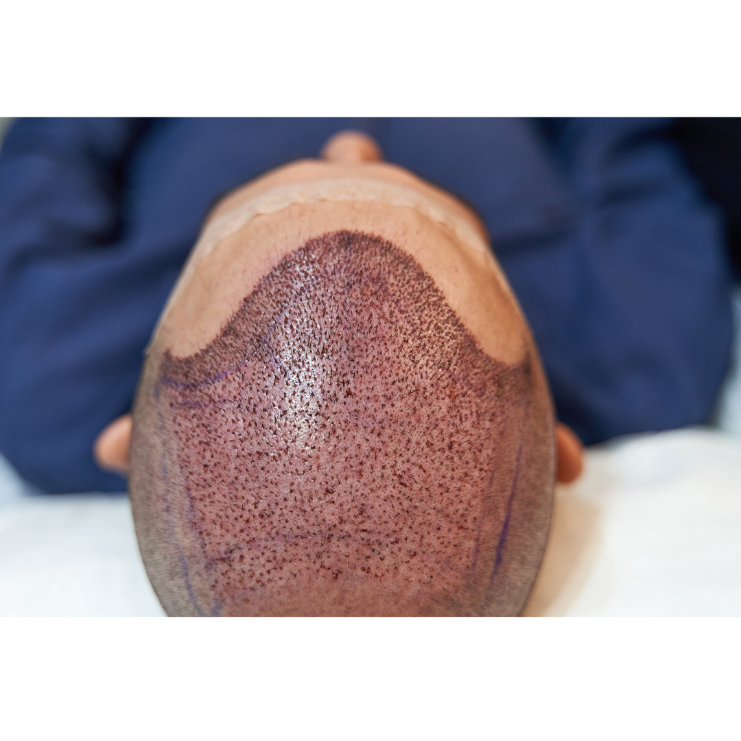 Post-Hair Transplant Care