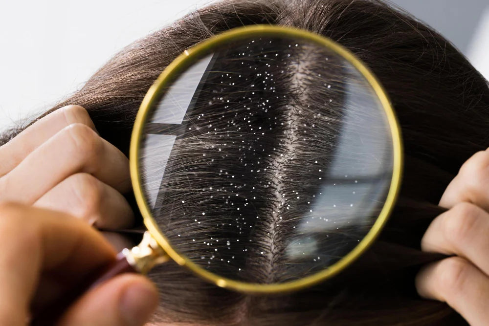 Dandruff and Seborrheic Dermatitis - A Help Guide
