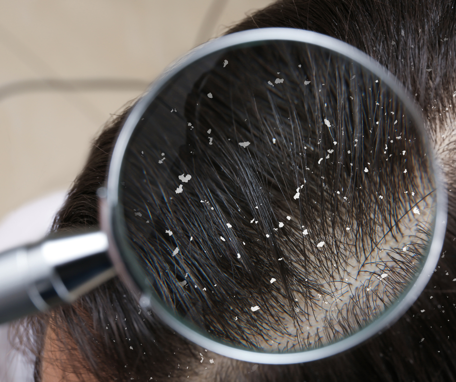 STOP Dandruff